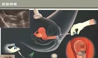 体外受精 IVF-ET